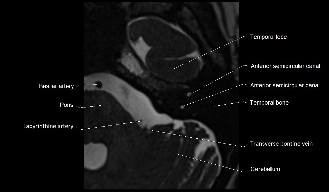 Internal auditory canal (IAC) axial cross sectional anatomy image 22.webp
